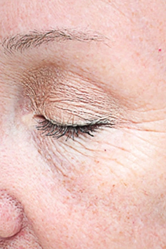 Before VI Peel Advanced treatment showing wrinkles, skin laxity, or rough texture in Louisville