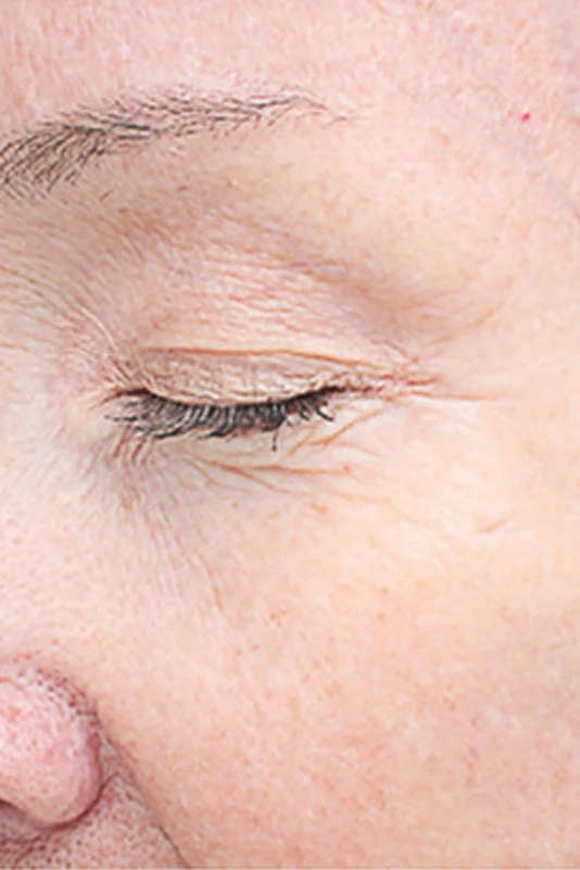 After VI Peel Advanced treatment showing firmer skin and reduced fine lines in Louisville