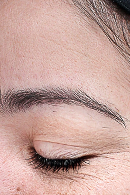 Before VI Peel Advanced treatment showing wrinkles, skin laxity, or rough texture in Louisville