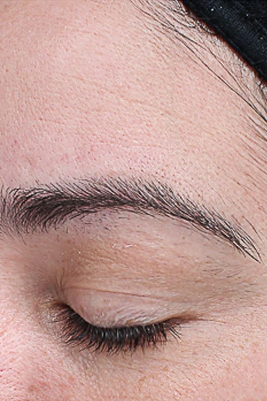 After VI Peel Advanced treatment showing firmer skin and reduced fine lines in Louisville