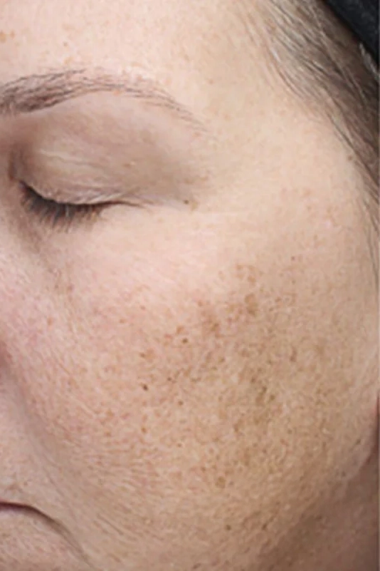 Before VI Peel Advanced treatment showing wrinkles, skin laxity, or rough texture in Louisville