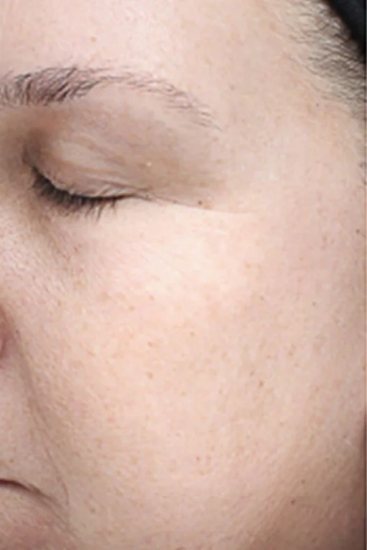 After VI Peel Advanced treatment showing firmer skin and reduced fine lines in Louisville