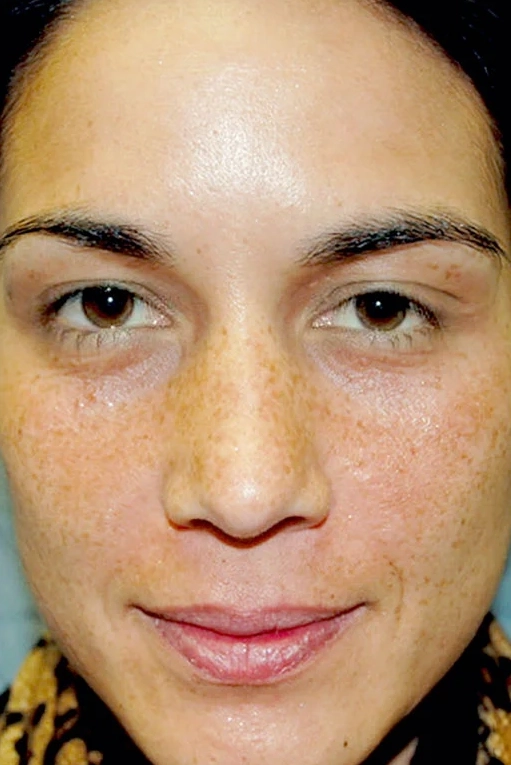 Before VI Peel Advanced treatment showing wrinkles, skin laxity, or rough texture in Louisville
