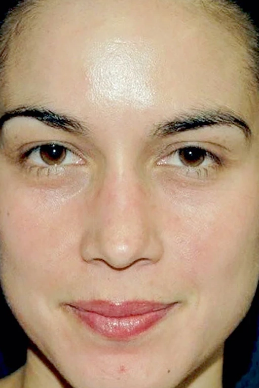After VI Peel Advanced treatment showing firmer skin and reduced fine lines in Louisville