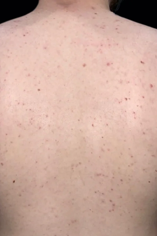 Before VI Peel Body treatment showing body acne, discoloration, scars, or stretch marks in Louisville
