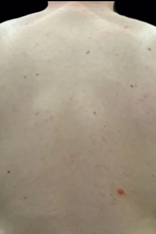 After VI Peel Body treatment showing smoother, more even-toned skin in Louisville