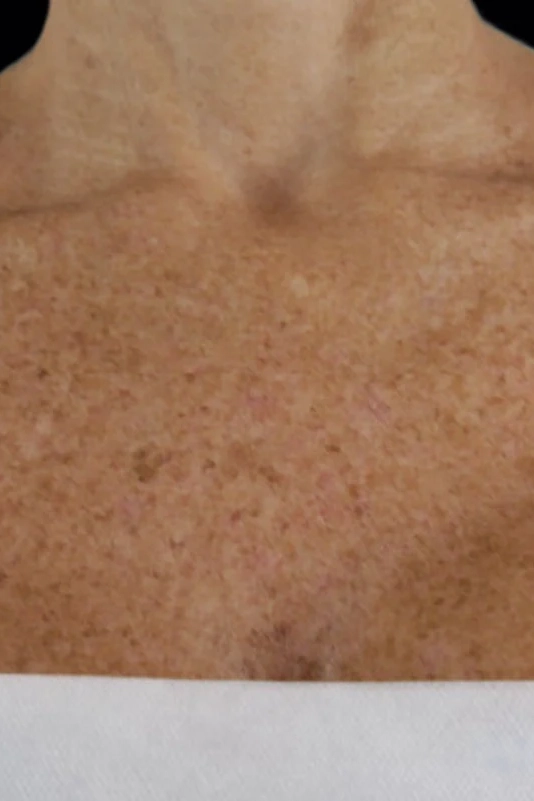 Before VI Peel Body treatment showing body acne, discoloration, scars, or stretch marks in Louisville
