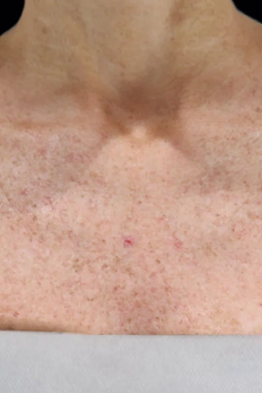 After VI Peel Body treatment showing smoother, more even-toned skin in Louisville