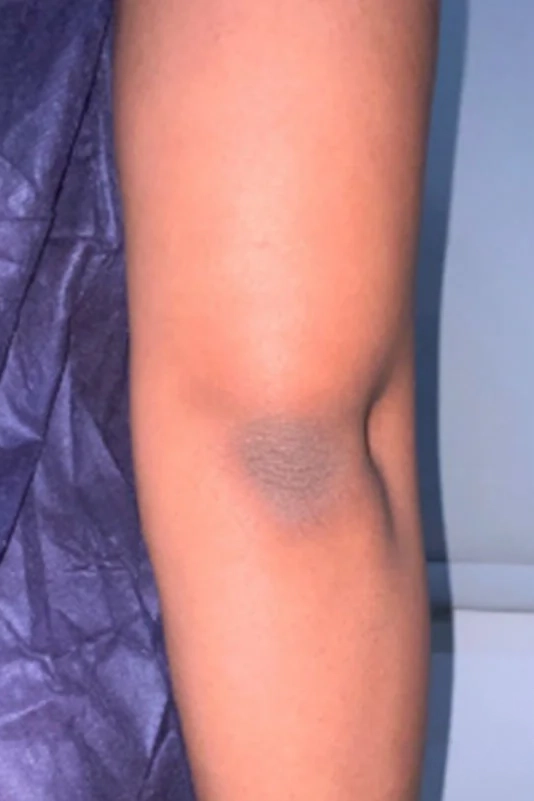 Before VI Peel Body treatment showing body acne, discoloration, scars, or stretch marks in Louisville