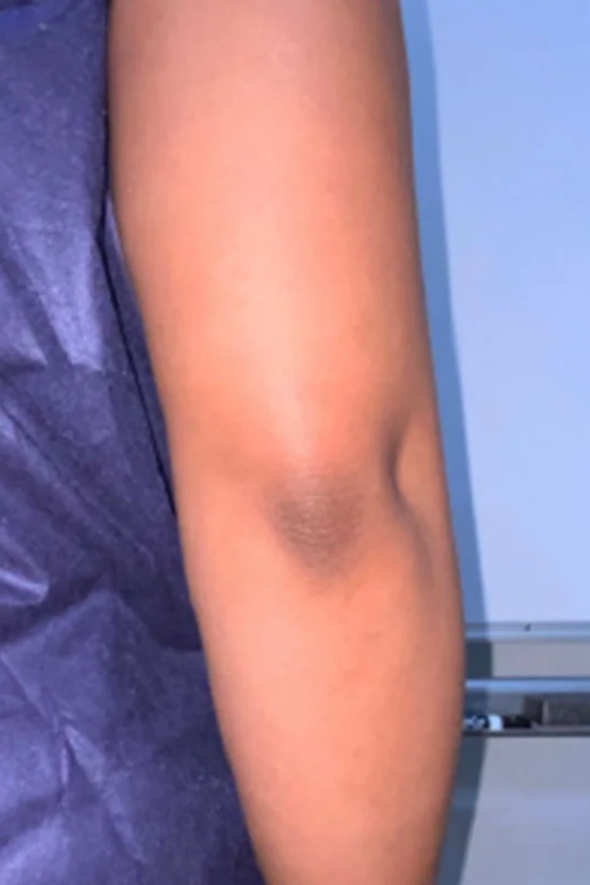 After VI Peel Body treatment showing smoother, more even-toned skin in Louisville