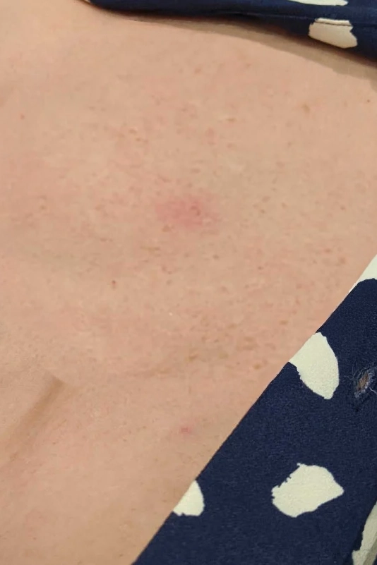 Before VI Peel Body treatment showing body acne, discoloration, scars, or stretch marks in Louisville