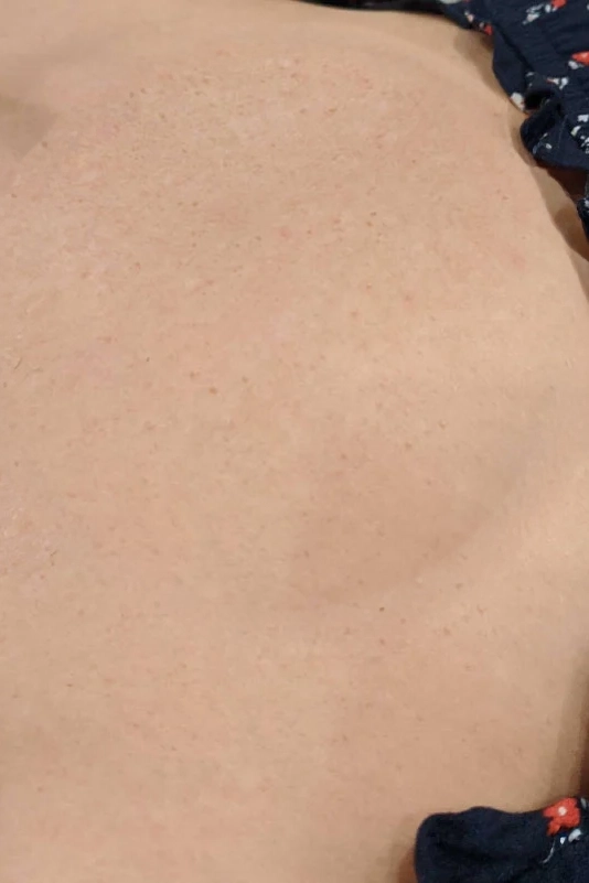 After VI Peel Body treatment showing smoother, more even-toned skin in Louisville