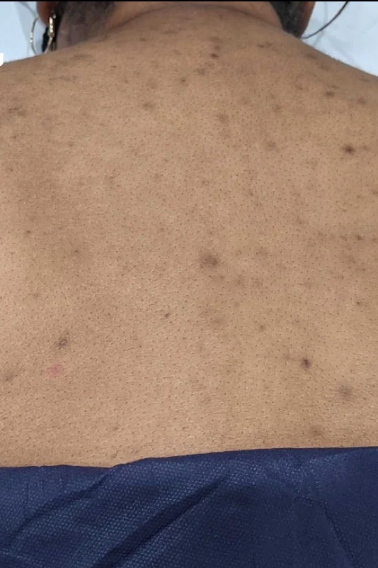 Before VI Peel Body treatment showing body acne, discoloration, scars, or stretch marks in Louisville