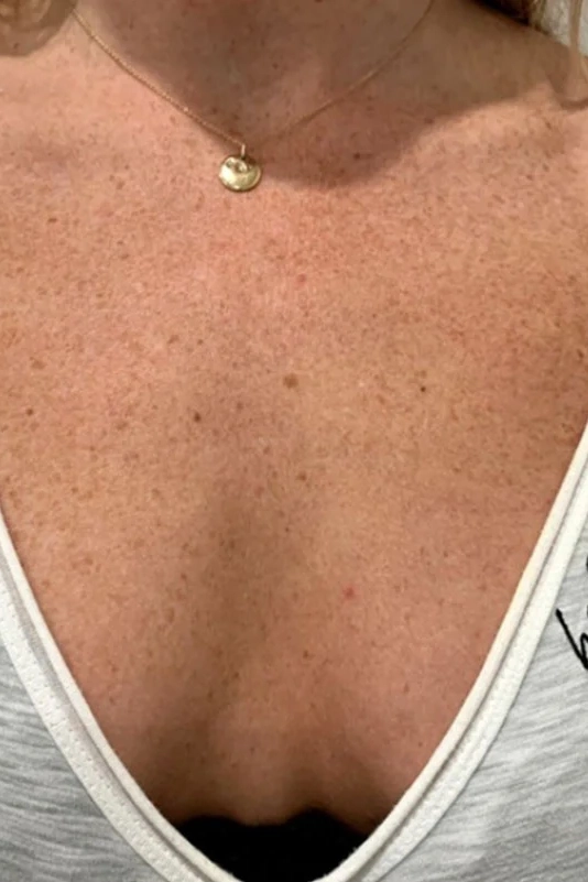 Before VI Peel Body treatment showing body acne, discoloration, scars, or stretch marks in Louisville