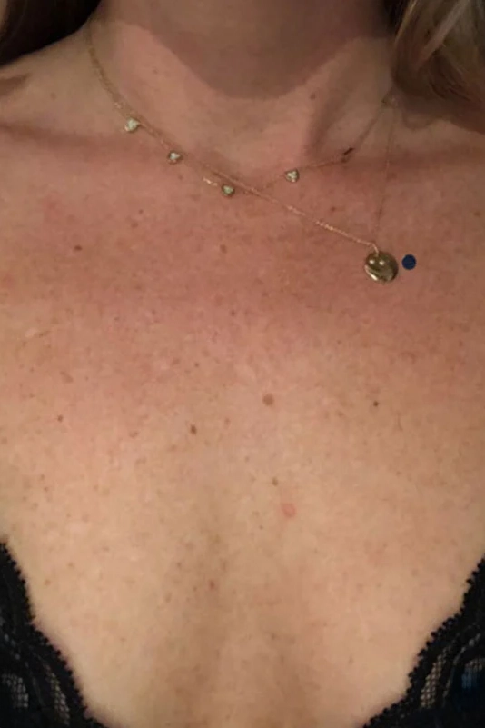 After VI Peel Body treatment showing smoother, more even-toned skin in Louisville