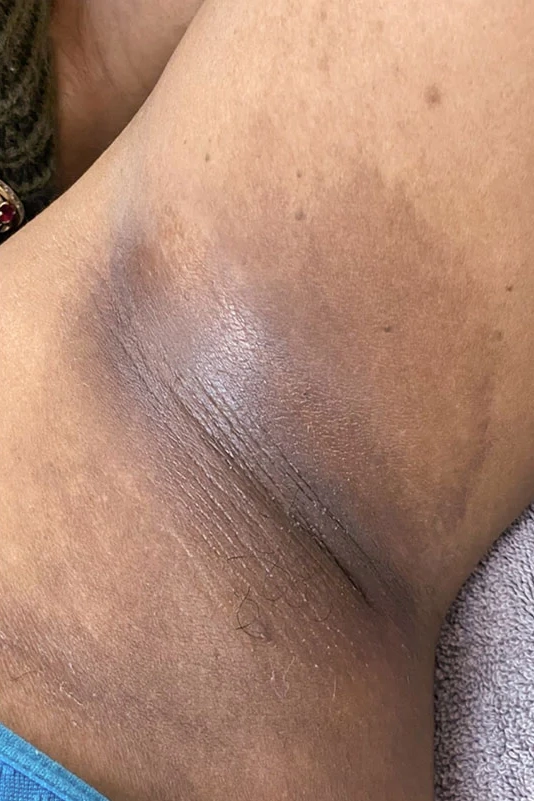Before VI Peel Body treatment showing body acne, discoloration, scars, or stretch marks in Louisville
