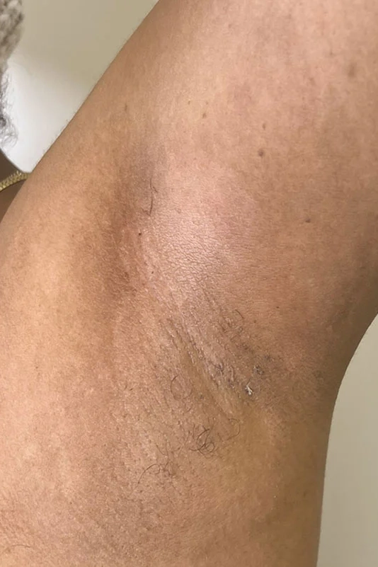 After VI Peel Body treatment showing smoother, more even-toned skin in Louisville