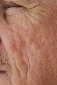 After microneedling treatment showing smoother texture and improved skin tone in Louisville