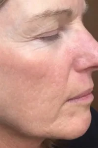 After microneedling treatment showing smoother texture and improved skin tone in Louisville