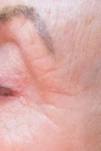 After microneedling treatment showing smoother texture and improved skin tone in Louisville