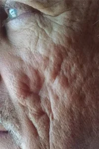 Before microneedling treatment showing acne scars, fine lines, or uneven skin tone in Louisville