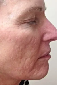 Before microneedling treatment showing acne scars, fine lines, or uneven skin tone in Louisville