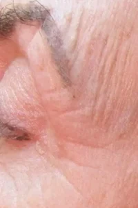 Before microneedling treatment showing acne scars, fine lines, or uneven skin tone in Louisville
