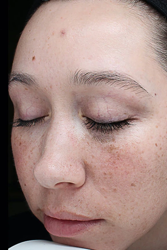 Before VI Peel Original treatment showing dull skin, uneven texture, or early signs of aging in Louisville