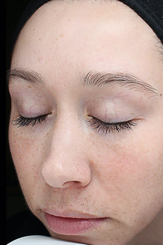After VI Peel Original treatment showing brighter, smoother, more refreshed skin in Louisville