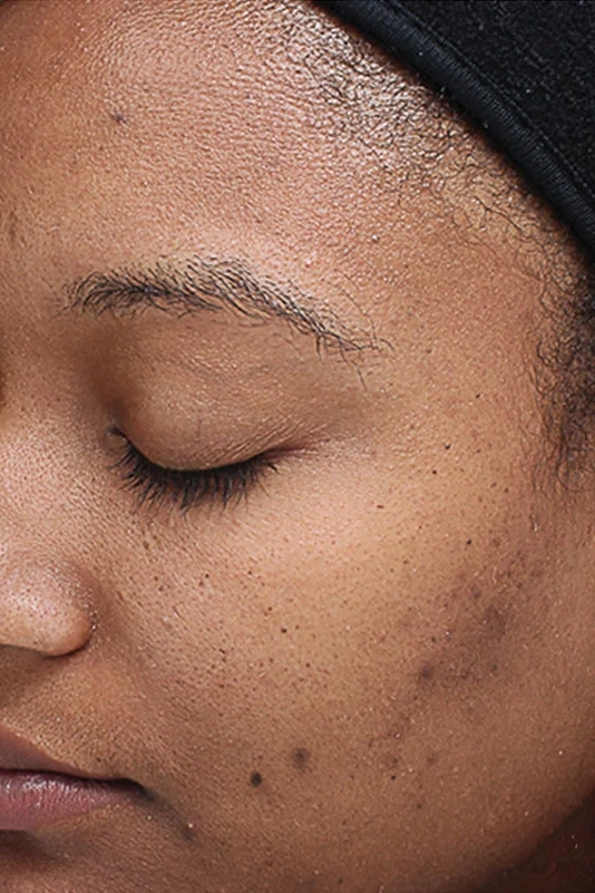 Before VI Peel Original treatment showing dull skin, uneven texture, or early signs of aging in Louisville