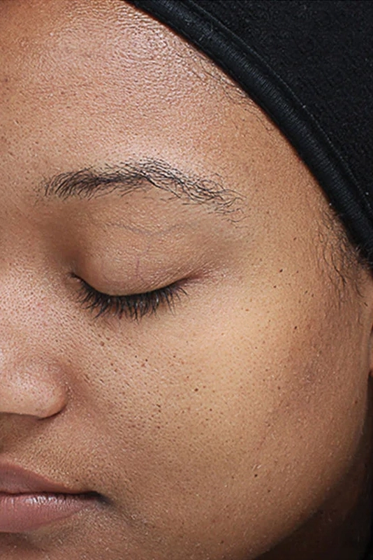 After VI Peel Original treatment showing brighter, smoother, more refreshed skin in Louisville