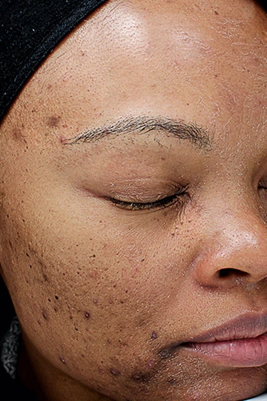Before VI Peel Original treatment showing dull skin, uneven texture, or early signs of aging in Louisville
