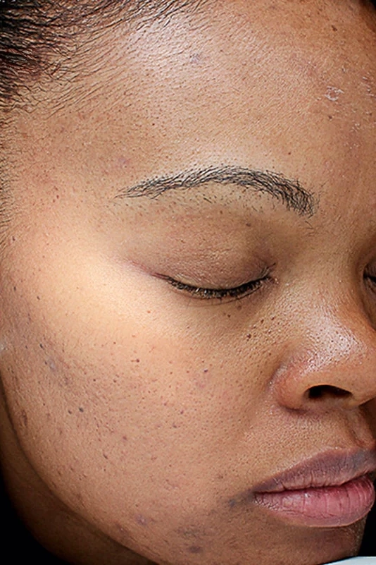 After VI Peel Original treatment showing brighter, smoother, more refreshed skin in Louisville