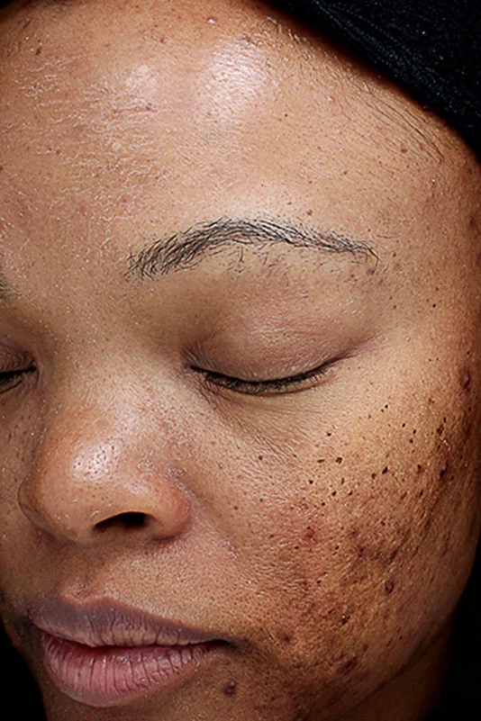 Before VI Peel Original treatment showing dull skin, uneven texture, or early signs of aging in Louisville