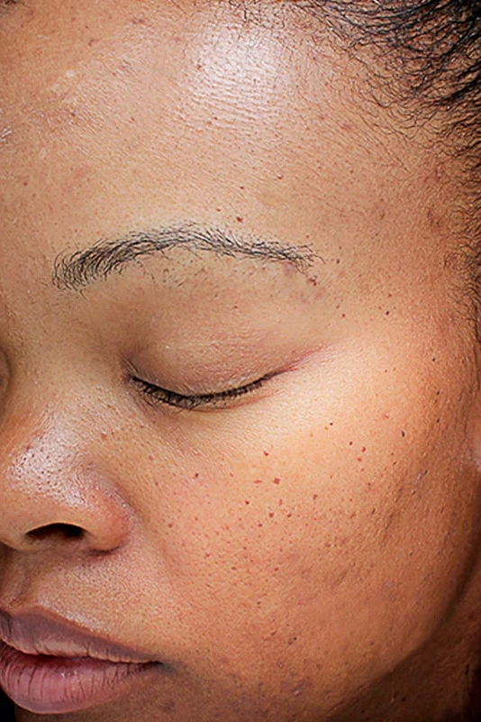 After VI Peel Original treatment showing brighter, smoother, more refreshed skin in Louisville
