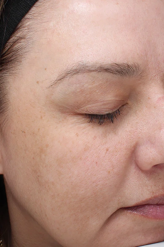 After VI Peel Precision treatment showing reduced pigmentation and improved skin clarity in Louisville