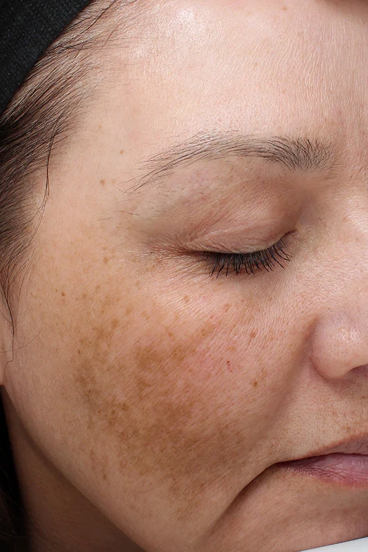 Before VI Peel Precision treatment showing hyperpigmentation, melasma, or uneven skin tone in Louisville