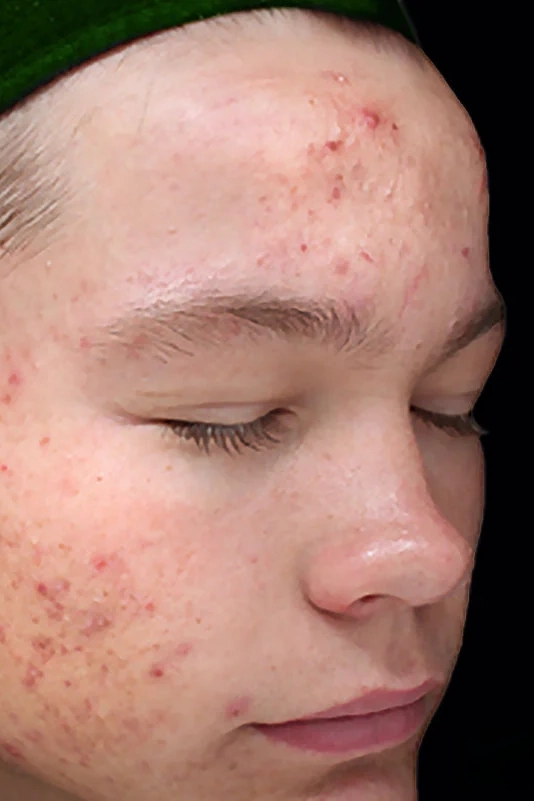 Before VI Peel Purify treatment showing active acne and congested, oily skin in Louisville