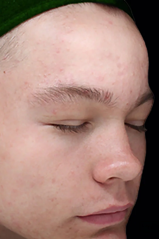 After VI Peel Purify treatment showing clearer pores and balanced skin in Louisville