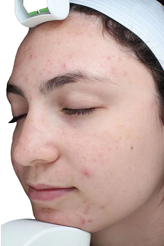 Before VI Peel Purify treatment showing active acne and congested, oily skin in Louisville