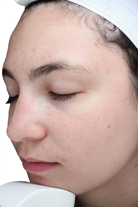 After VI Peel Purify treatment showing clearer pores and balanced skin in Louisville