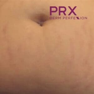 After PRX Derm Perfexion treatment showing firmer, brighter, more hydrated skin in Louisville
