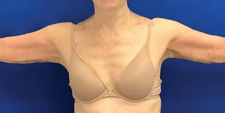 After Renuvion J-Plasma skin tightening showing firmer, tighter skin and improved contour in Louisville
