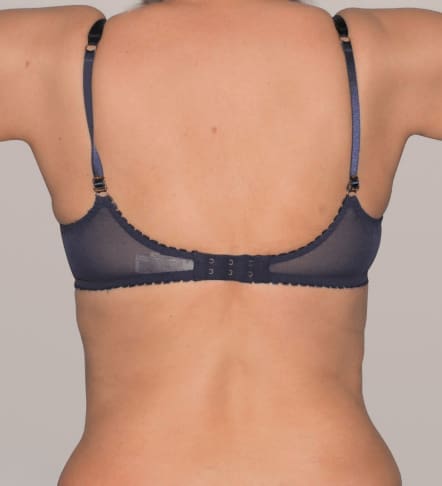After Renuvion J-Plasma skin tightening showing firmer, tighter skin and improved contour in Louisville