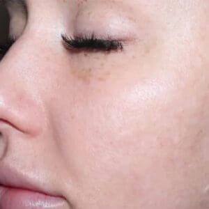 After ELEVAI exosome skincare showing improved skin clarity, tone, and texture in Louisville