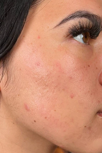 After HydraFacial MD treatment showing brighter, smoother, hydrated skin in Louisville