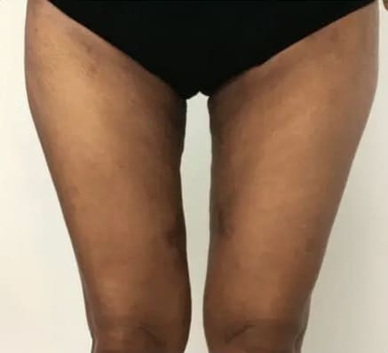 After Renuvion J-Plasma skin tightening showing firmer, tighter skin and improved contour in Louisville