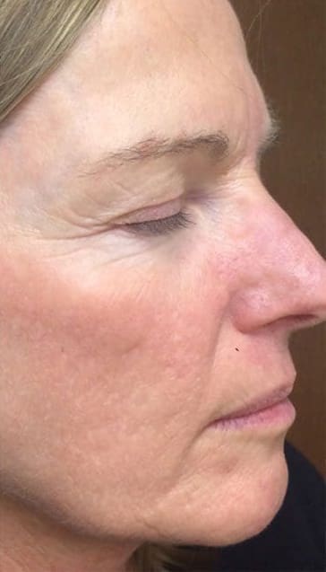 After Vivace RF microneedling treatment showing firmer, smoother, more even-looking skin in Louisville