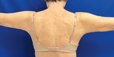 After Renuvion J-Plasma skin tightening showing firmer, tighter skin and improved contour in Louisville