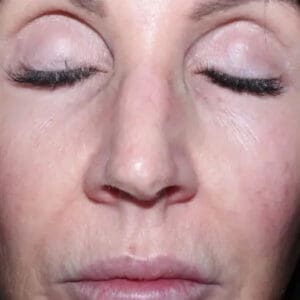After ELEVAI exosome skincare showing improved skin clarity, tone, and texture in Louisville